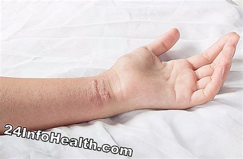 Sintomi, cause e domande comuni di arrossamento della mano